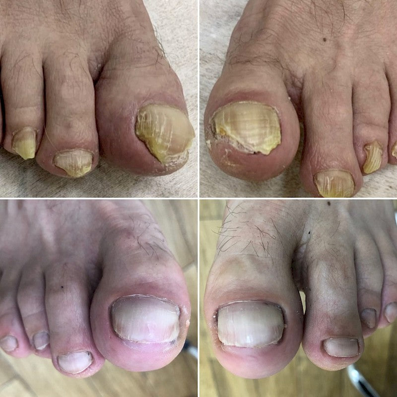 Fungal Nail Removal