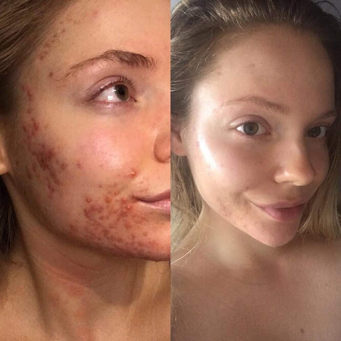 The Ultimate Solution for Stubborn Acne: Laser Treatment!