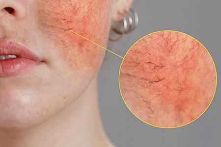 The Ultimate Guide to Removing Broken Capillaries with Lasers