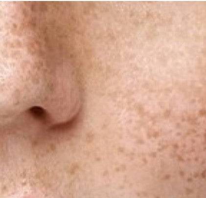 The Power of Pigmentation Laser Treatment: An Inspiring Guide