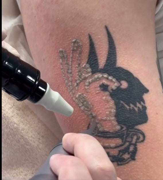 Learn about Laser Tattoo Removal