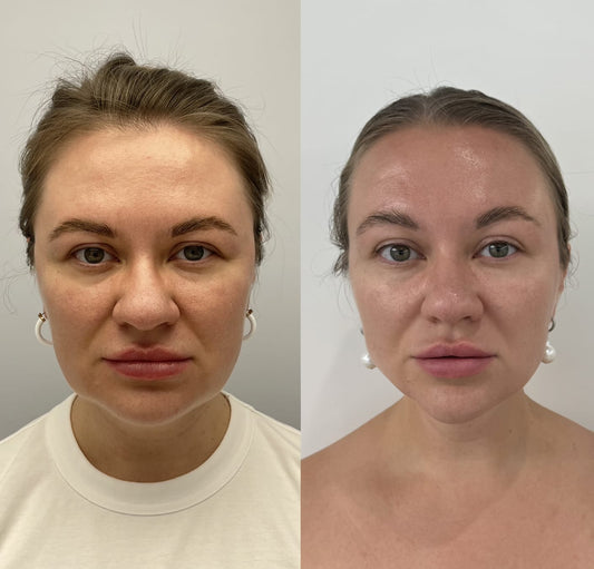 HIFU Full Facelift