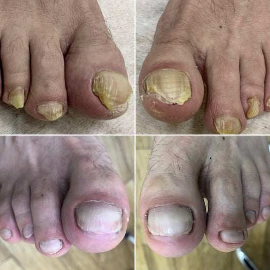 Fungal Nail Removal