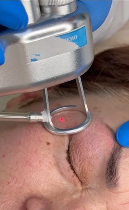 CO2 Laser Resurfacing for Small Area